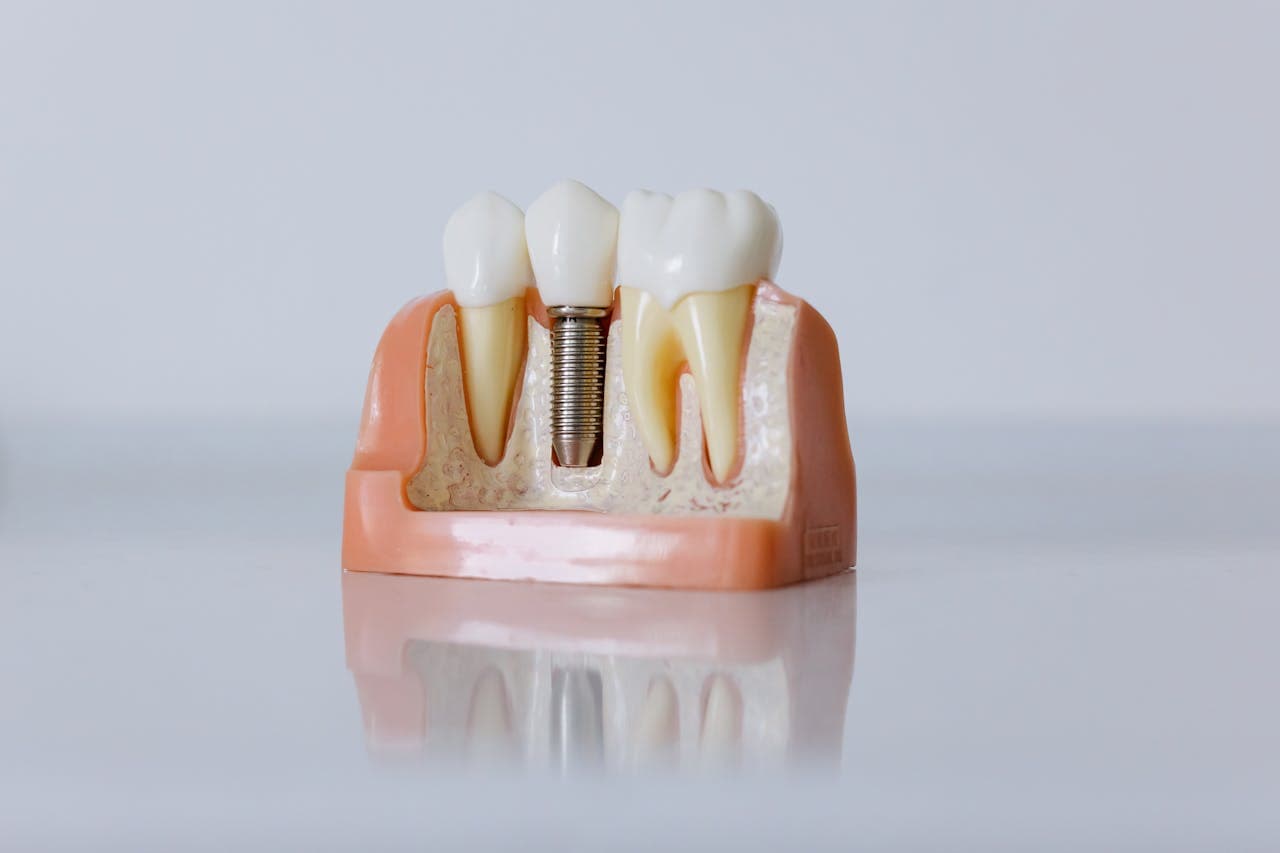Dental implants: a natural-looking implant result