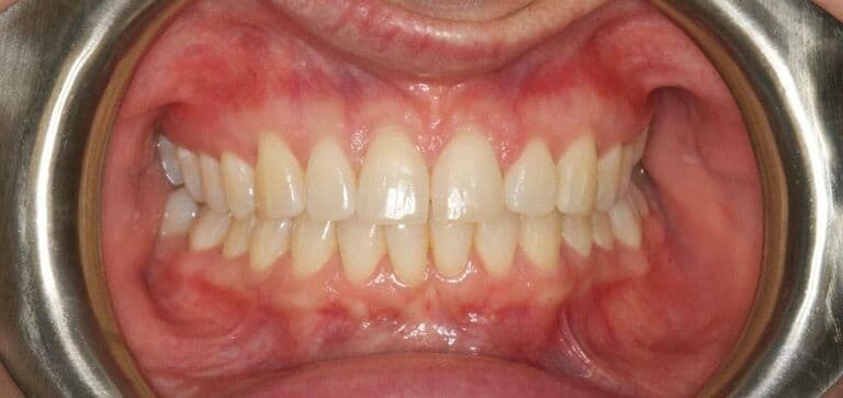 Gap closed for a more even smile: after treatment