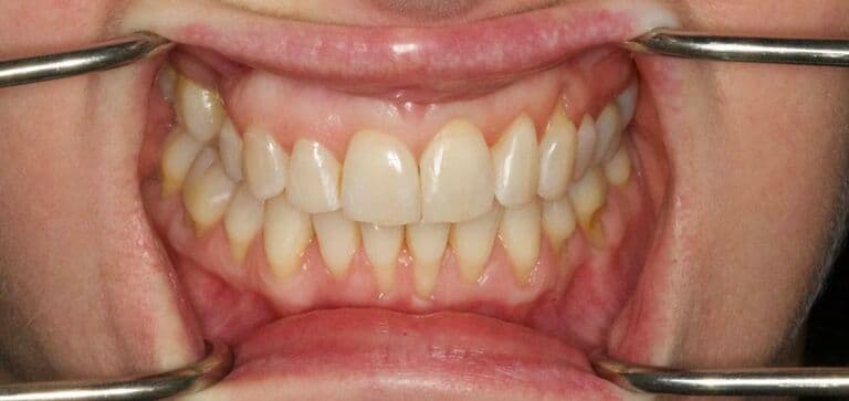 Crowding corrected, smile brightened: after treatment