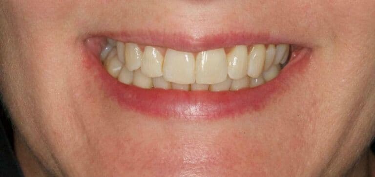 Crowded front teeth, straightened: after treatment
