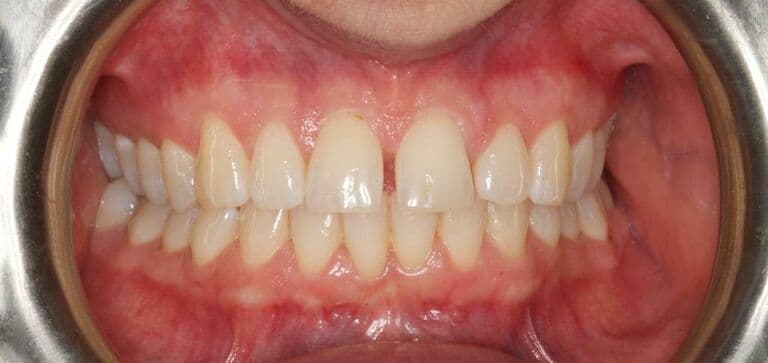 Gap closed for a more even smile: before treatment
