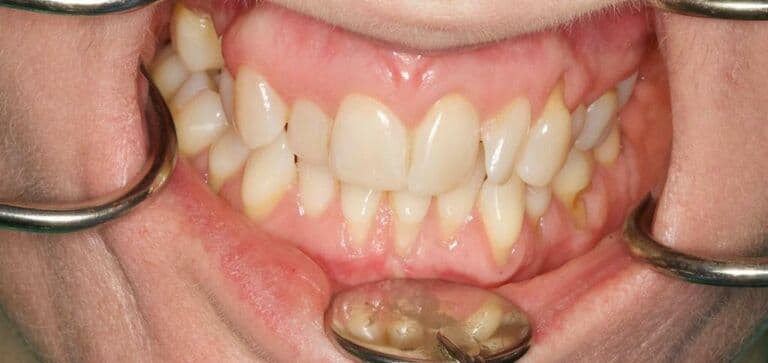 Crowding corrected, smile brightened: before treatment