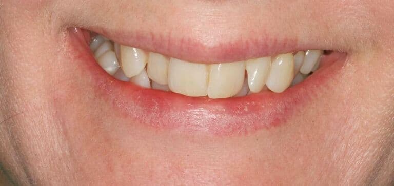 Crowded front teeth, straightened: before treatment