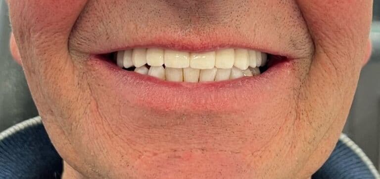 A confident, natural-looking smile: after treatment