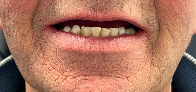 A confident, natural-looking smile: before treatment