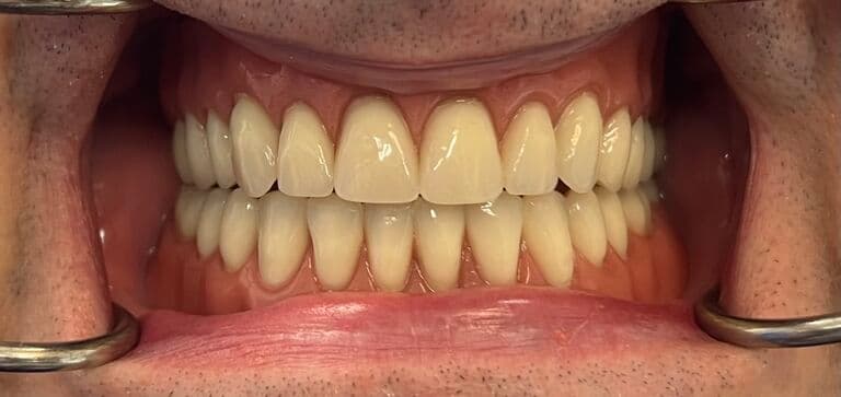 Smile transformation with lasting results: after treatment