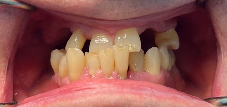 Smile transformation with lasting results: before treatment