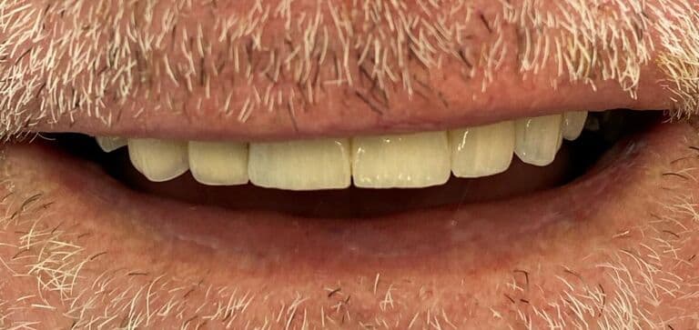 Missing teeth restored, confidence renewed: after treatment