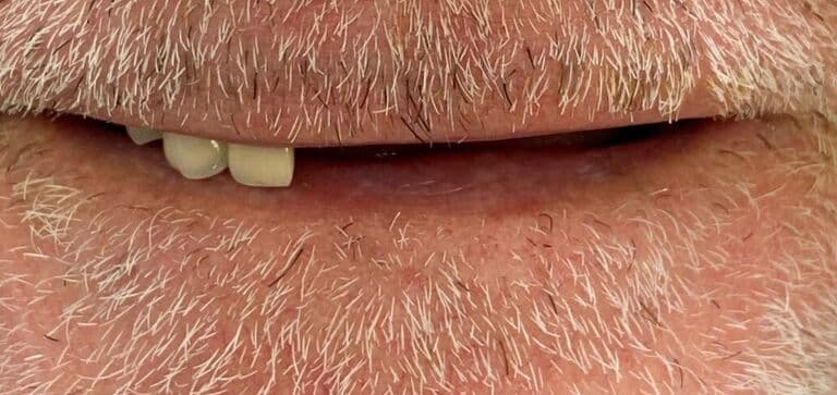 Missing teeth restored, confidence renewed: before treatment