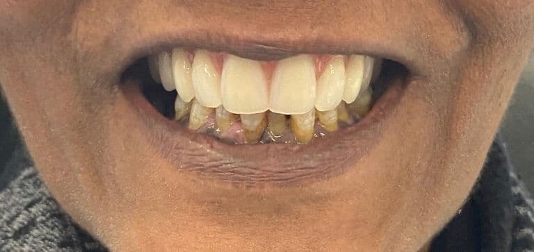 A brighter, healthier smile: after treatment
