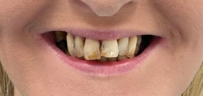 Straight, even teeth achieved: before treatment