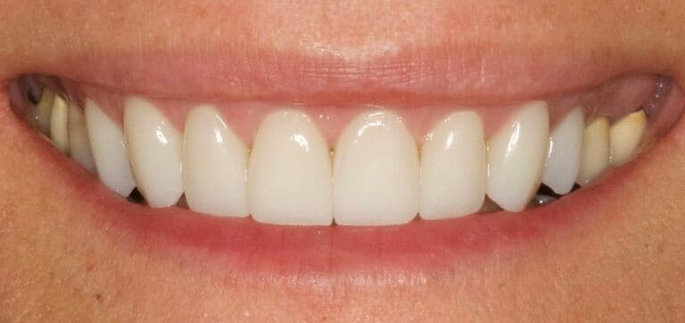 A complete smile makeover: after treatment