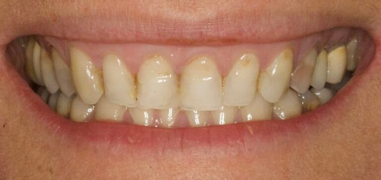 A complete smile makeover: before treatment