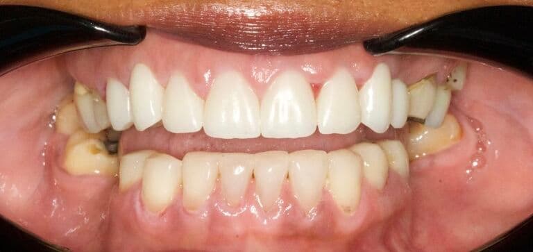 Natural-looking, long-lasting results: after treatment