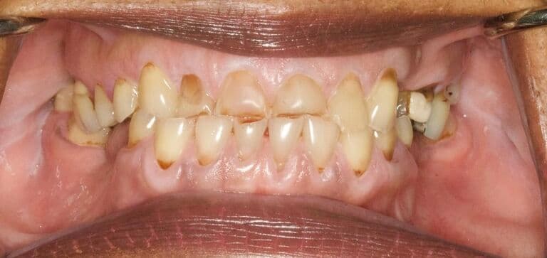 Natural-looking, long-lasting results: before treatment