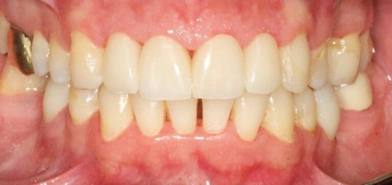 A smile our patient loves again: after treatment