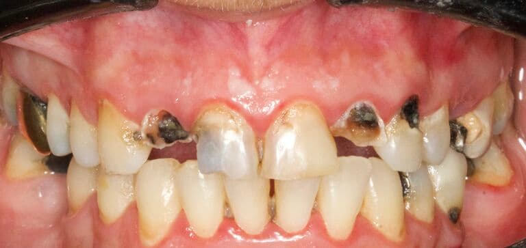 A smile our patient loves again: before treatment