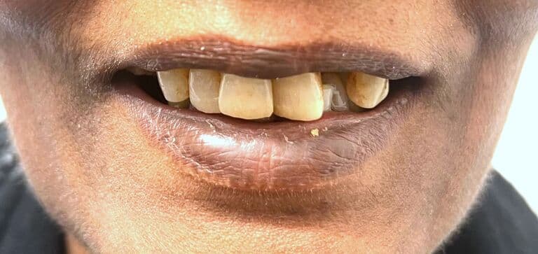 Ill-fitting dentures replaced with a fixed All-on-4 arch: before treatment