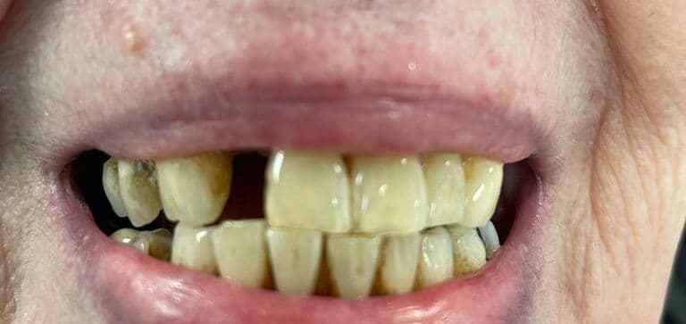 Missing tooth replaced with a natural-looking implant: after treatment