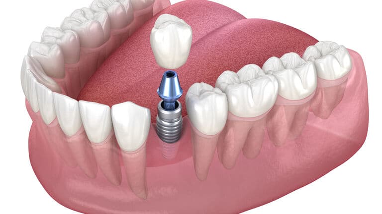 Diagram of a single tooth dental implant