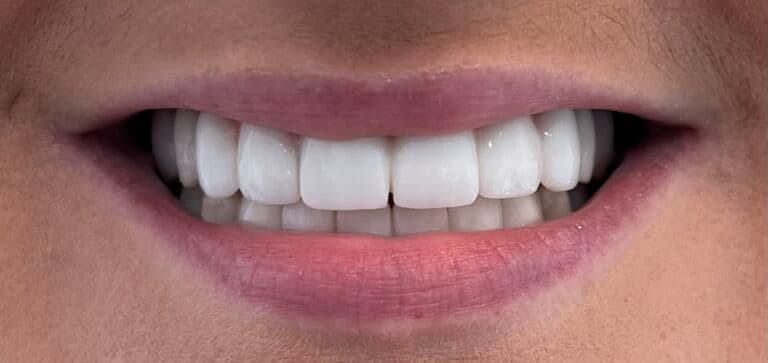 A full arch rebuilt with full arch restoration: after treatment