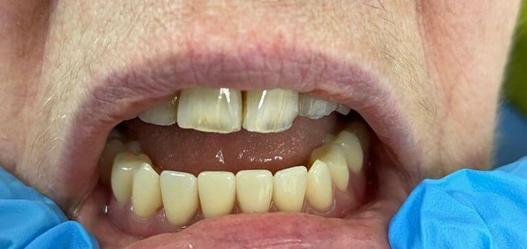 Several missing teeth replaced with multiple dental implants: after treatment