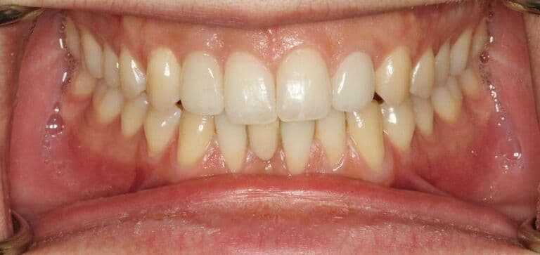 A secure, fixed result restoring bite and confidence: after treatment