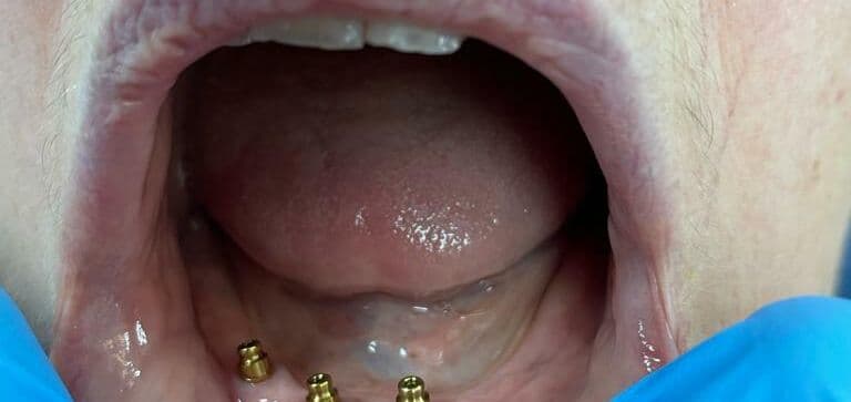 Several missing teeth replaced with multiple dental implants: before treatment