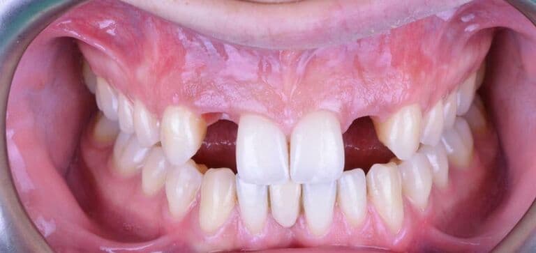 A secure, fixed result restoring bite and confidence: before treatment