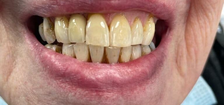 A missing tooth replaced with a single dental implant: before treatment