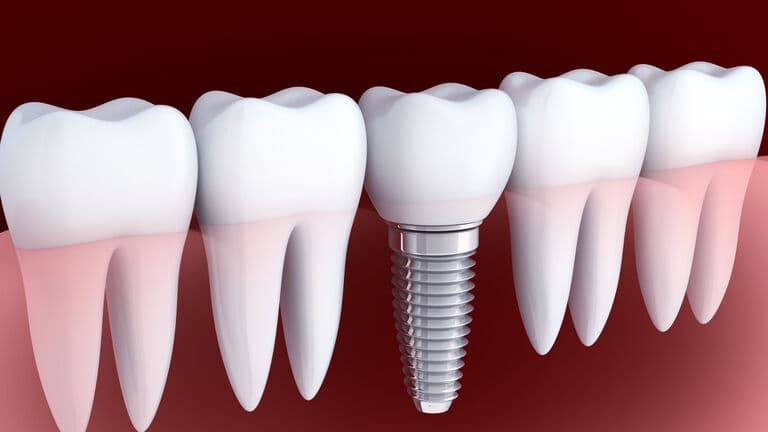 Diagram showing a single dental implant placed in the jawbone