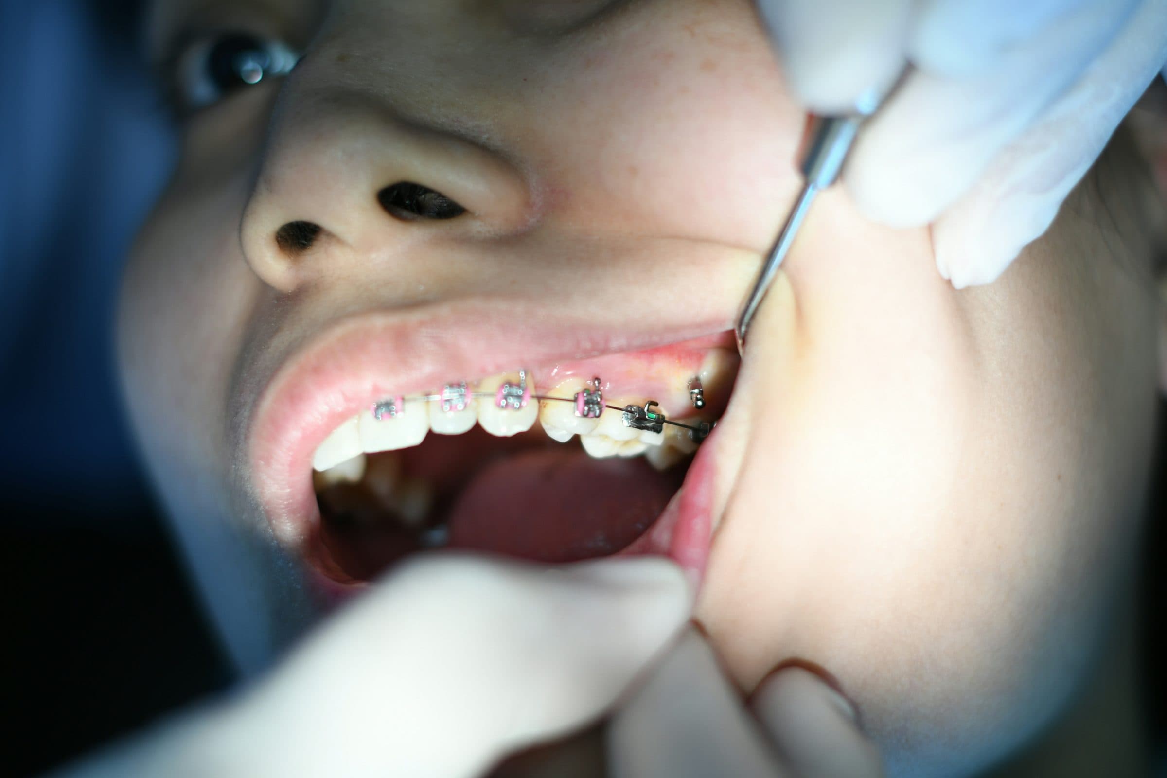 At What Age Should Your Kid Get Braces