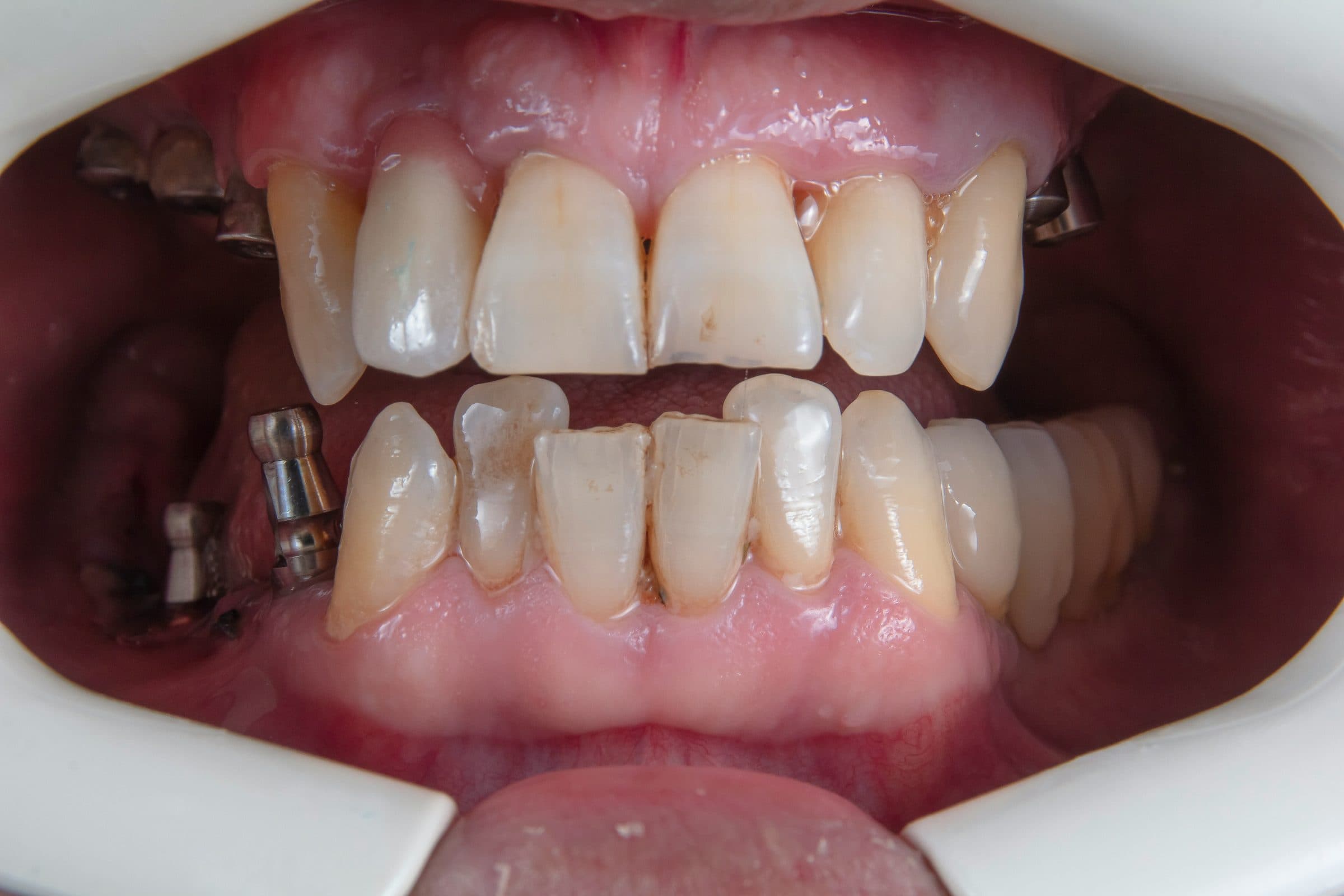 Bone Grafting Before Implants: What to Expect and Why It’s Needed