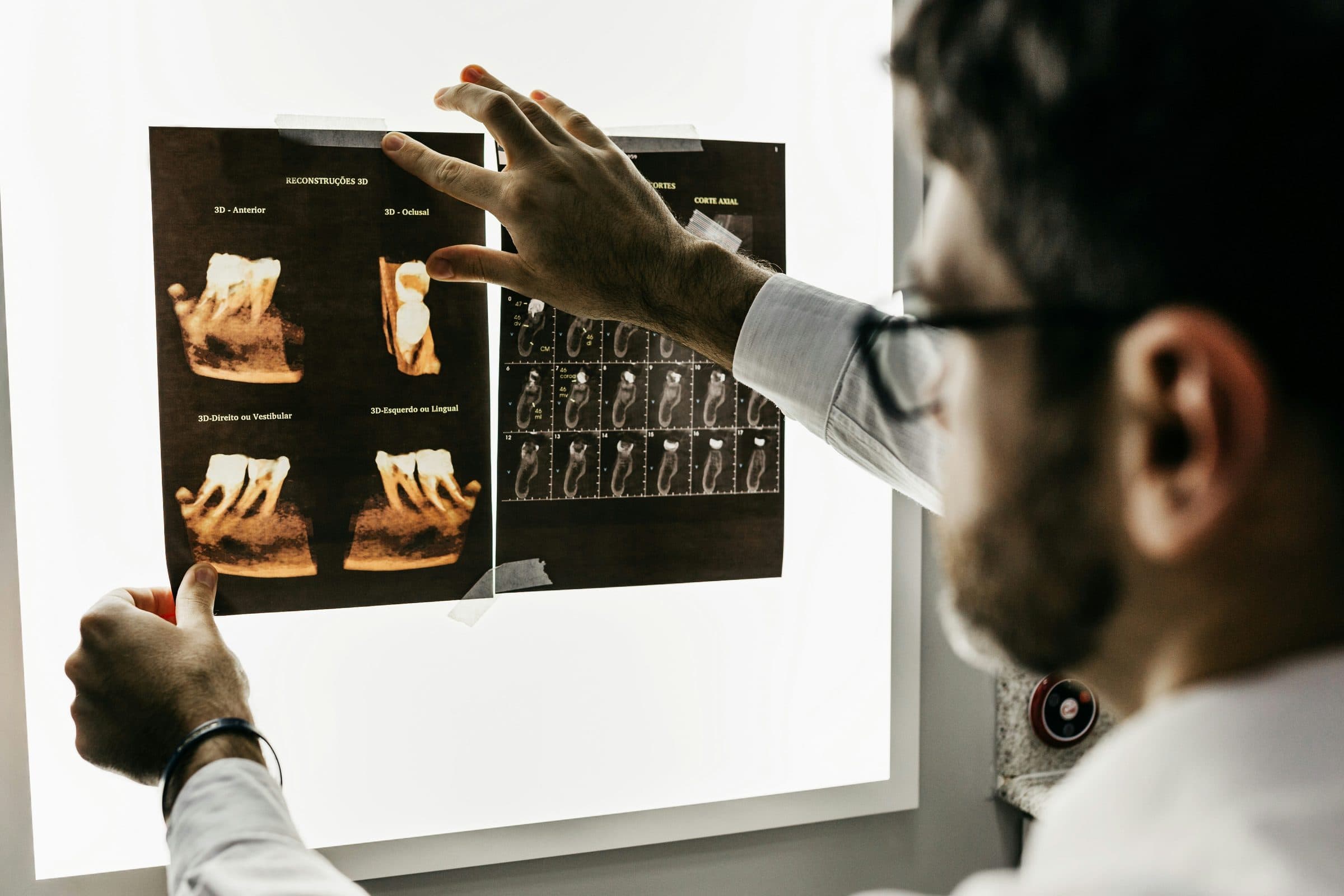 How to Prepare for Wisdom Tooth Surgery