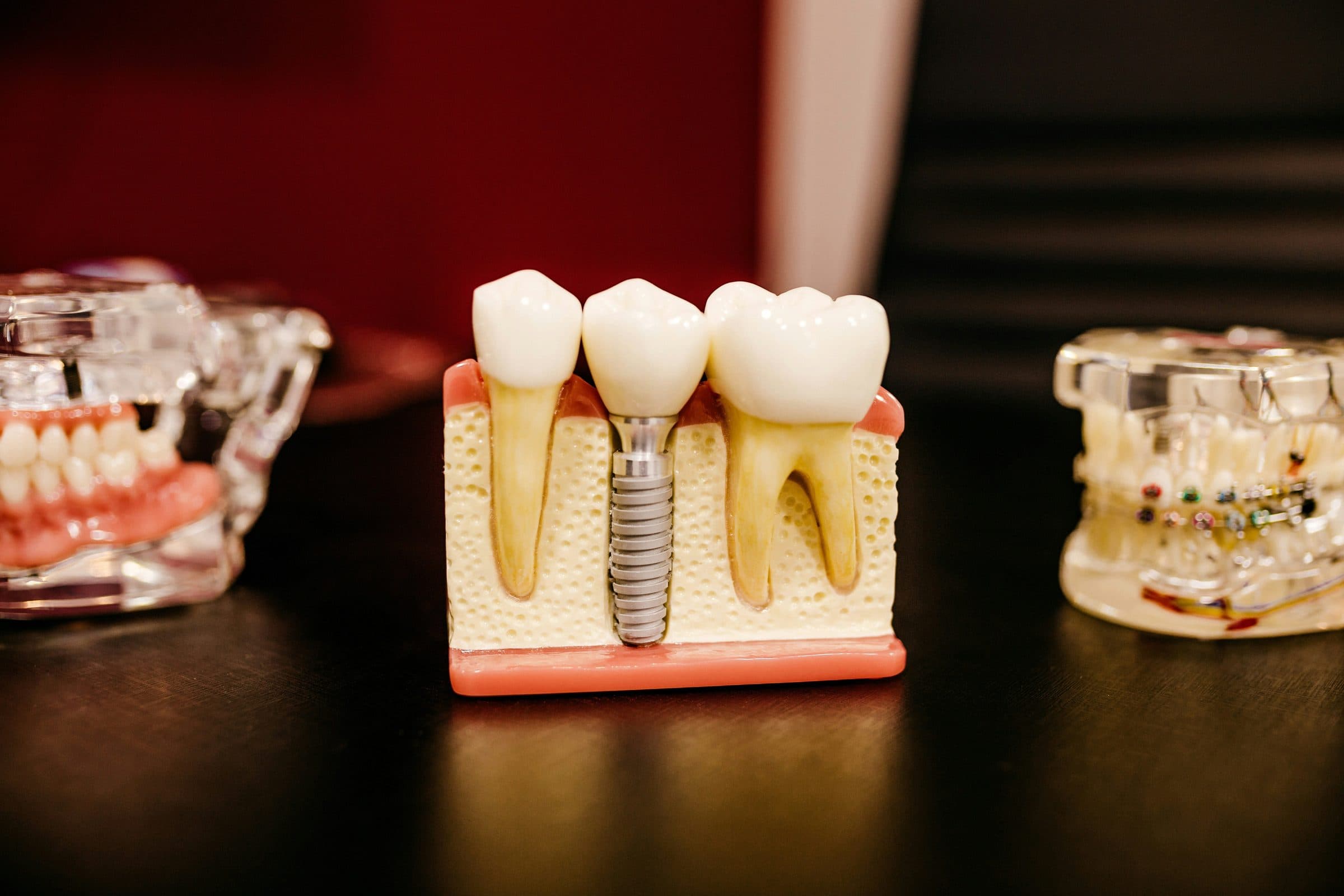 How Diet & Lifestyle Can Help (or Hinder) Your Implant Success