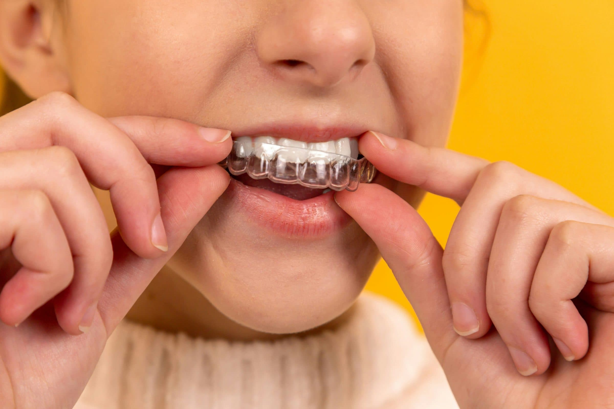 Difference Between Invisalign & Braces For Kids and Teens