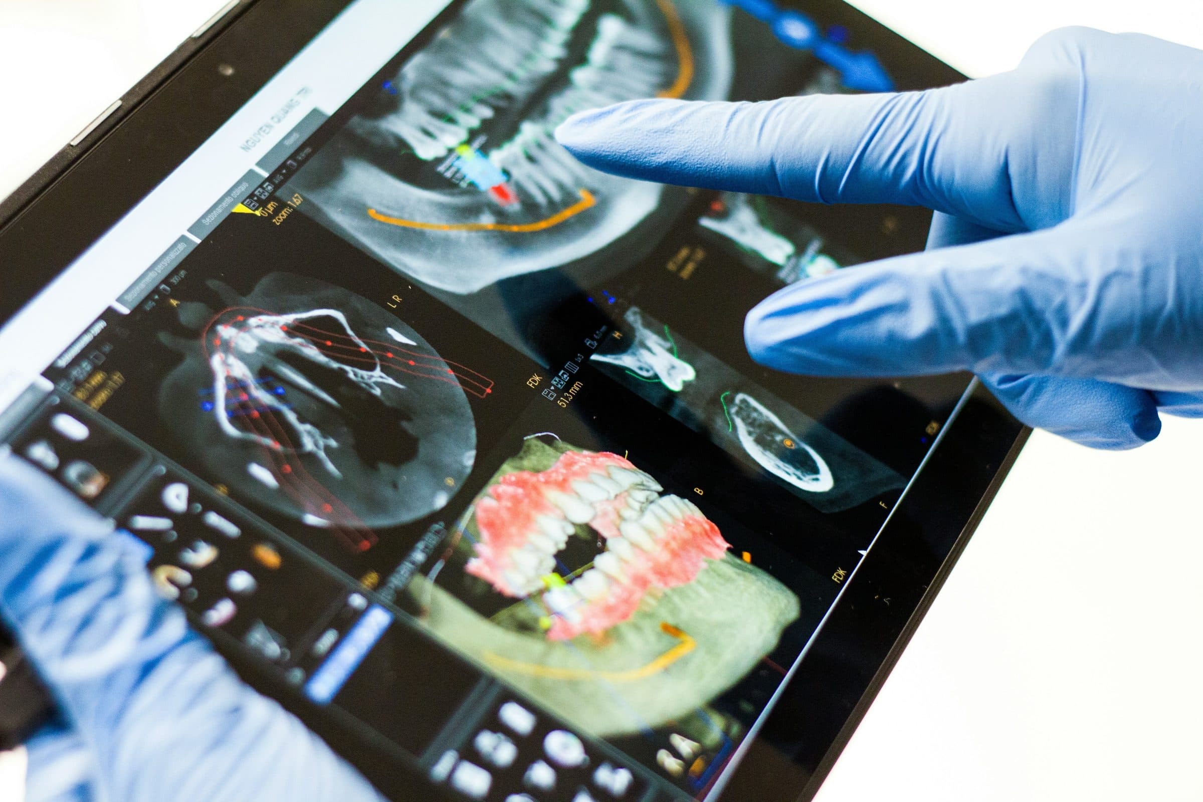 Everything You Need to Know About All-On‑4 Dental System