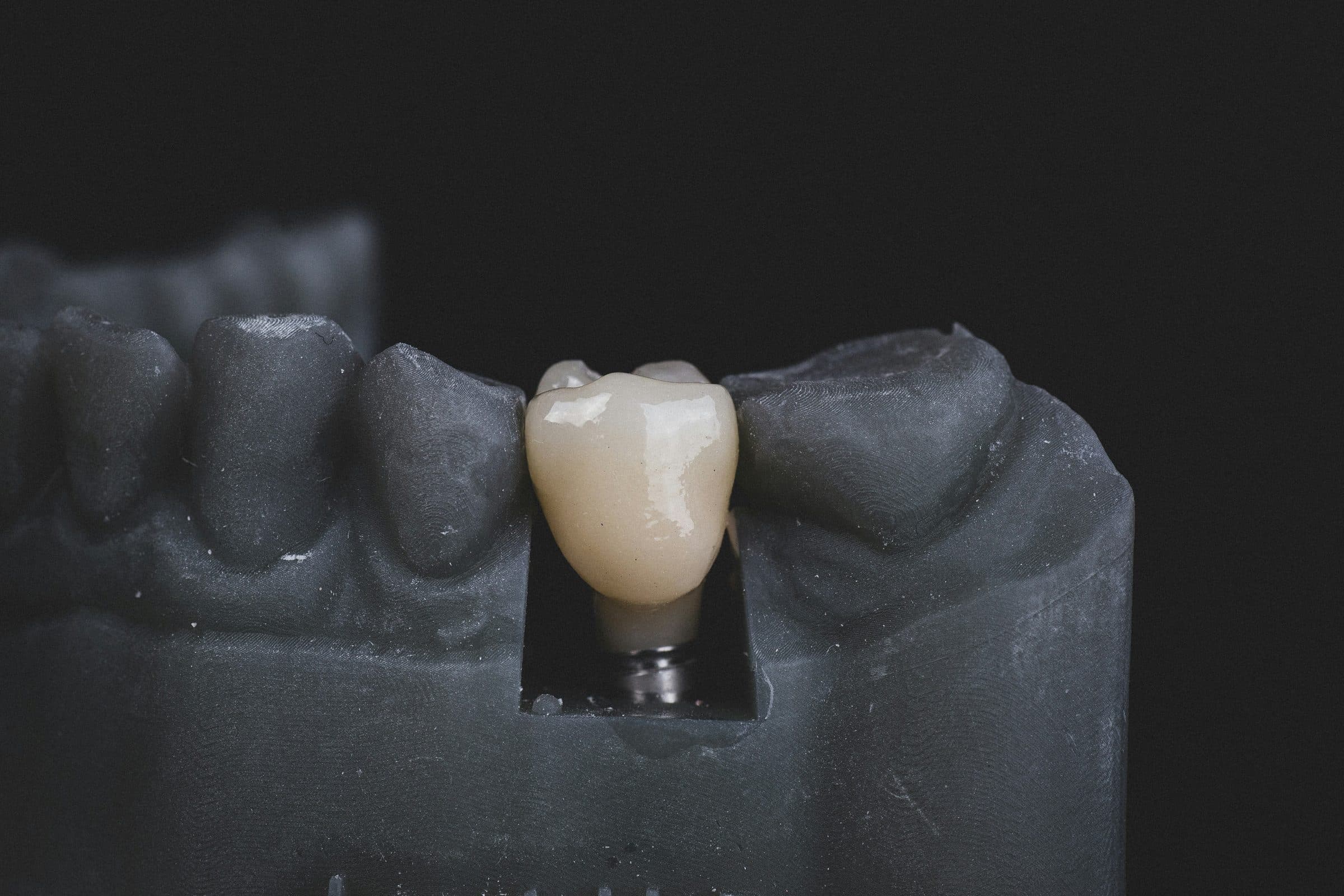 Managing Gum Disease to Ensure Implant Success