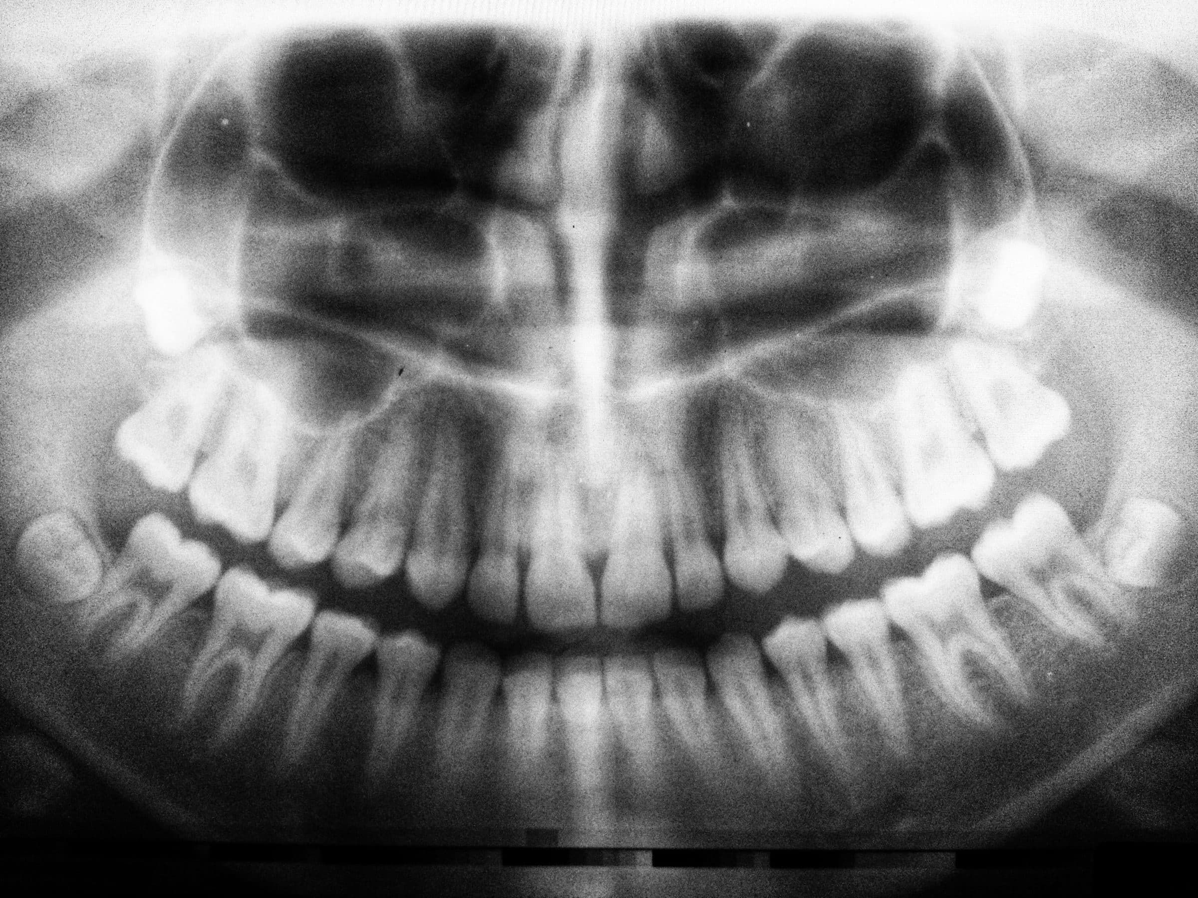 Top Tips for Caring for Your Mouth After Wisdom Teeth Surgery