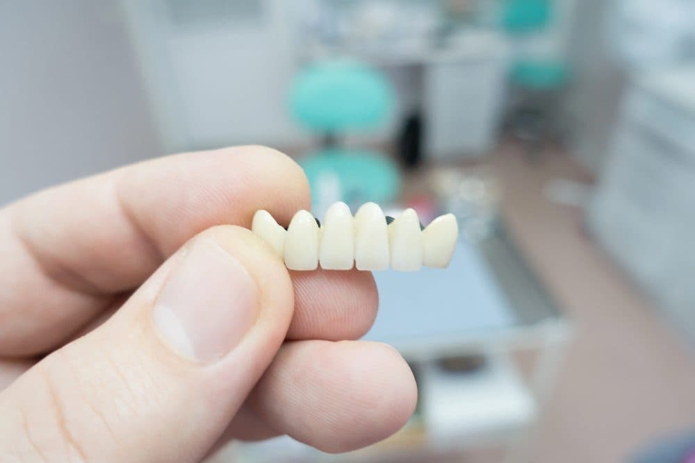 What are dental bridges