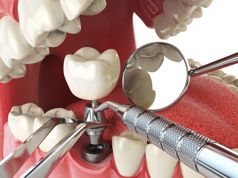 Which insurance providers offer dental implant coverage